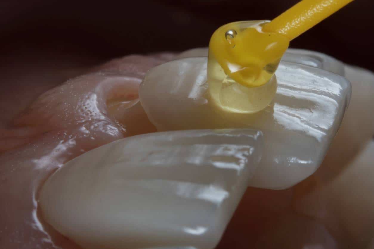 Pose de facettes dentaires